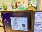 Петима възрастни пациенти вече живеят без постоянен катетър след емболизация на простатата